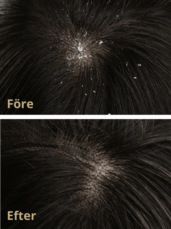 Dandruff Defense Treatment Gel - Bild 3